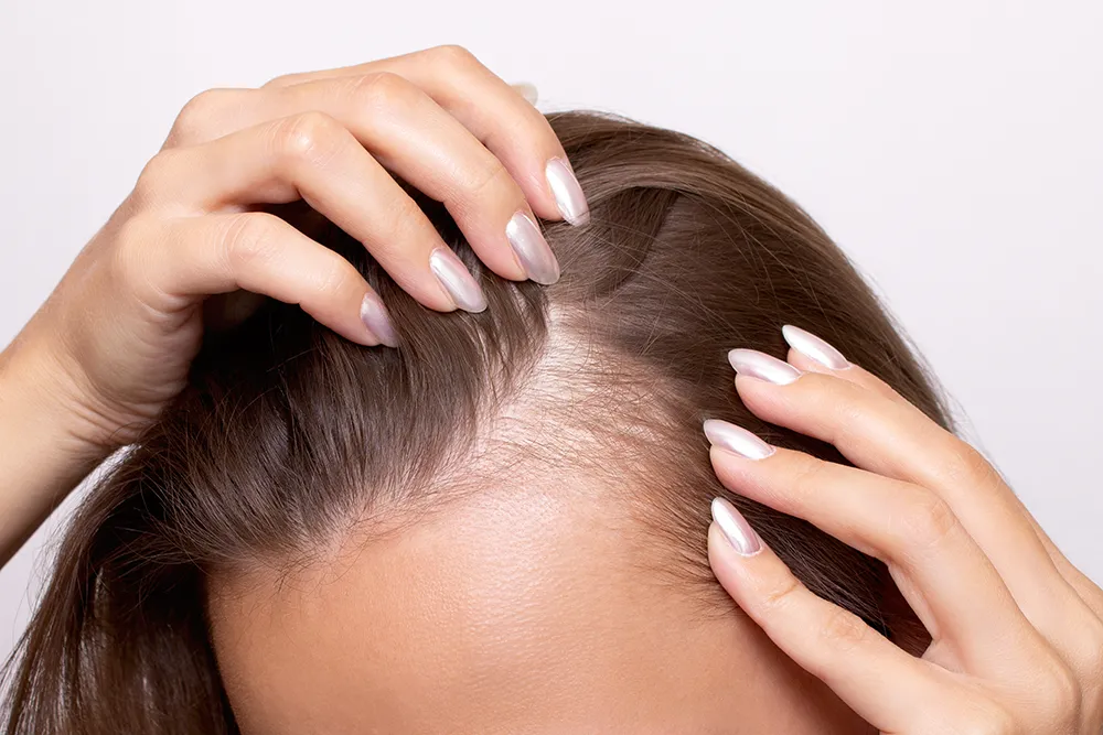 Exosomes Scalp Regeneration - Lisa Thompson Aesthetics
